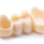 coronas-provisionales-dentista-protesis-valencia-diente