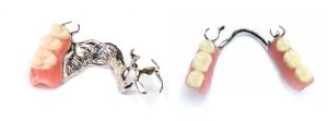 esqueletica-protesis-valencia-metal-dentista