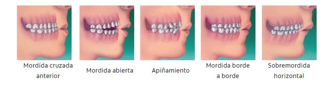 ortodoncia-tipos-patologías-maloclusiones-valencia