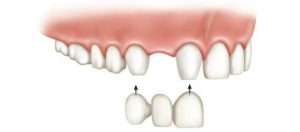 puente-dientes-dentista-valencia-protesis