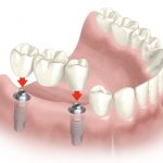 protesis-puente-valencia-dentista-implantes