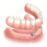 sobredentaduras-protesis-removibles-implantes-dentales