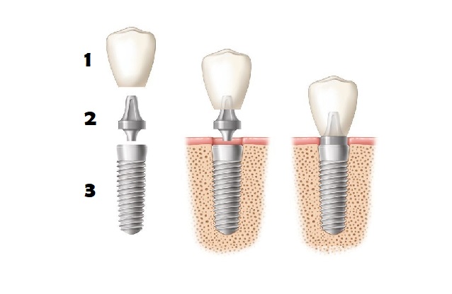 partes-de-implante-dental-valencia-drdemotta