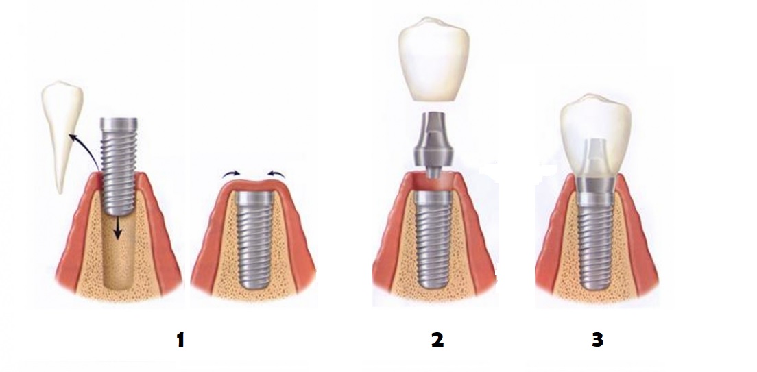 pasos-cirugía-implantes-dentales-valencia