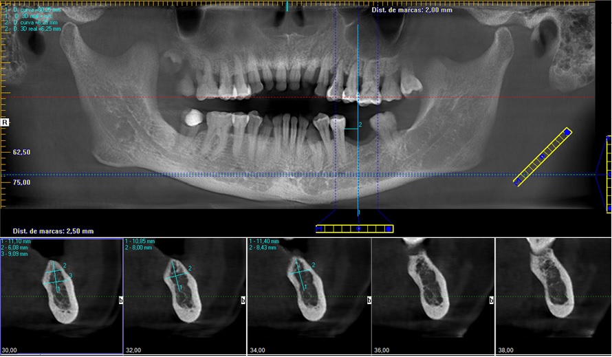 tac-drdemotta-valencia-cirugía-implante-dental